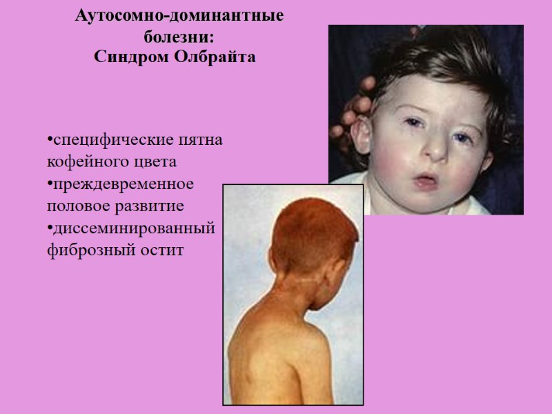 специфические пятна кофейного цвета преждевременное половое развитие диссеминированный фиброзный остит    